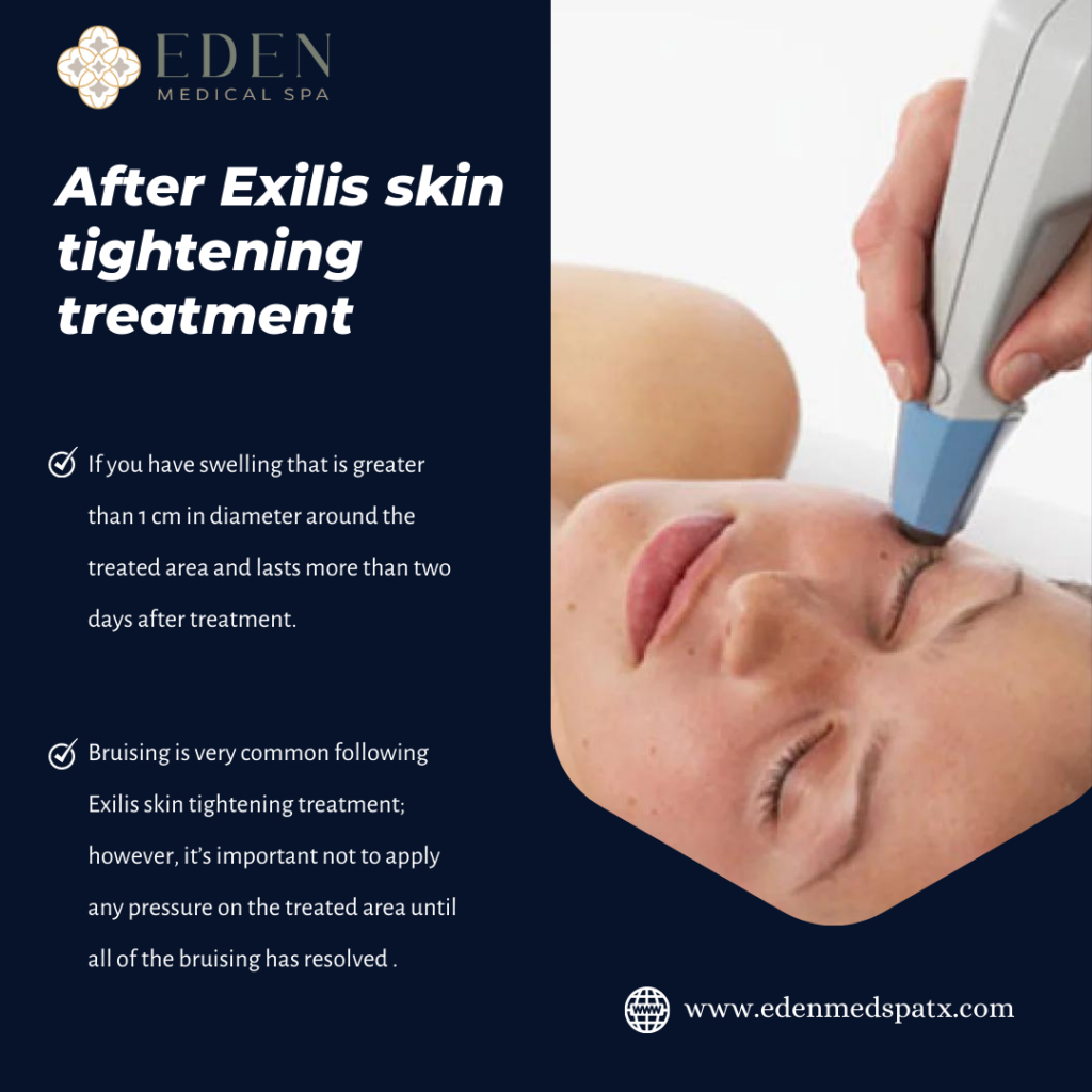 After Exilis Skin Tightening Treatment 1024x1024 1