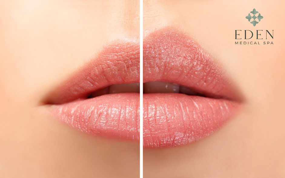Lip Fillers Austin TX Before After