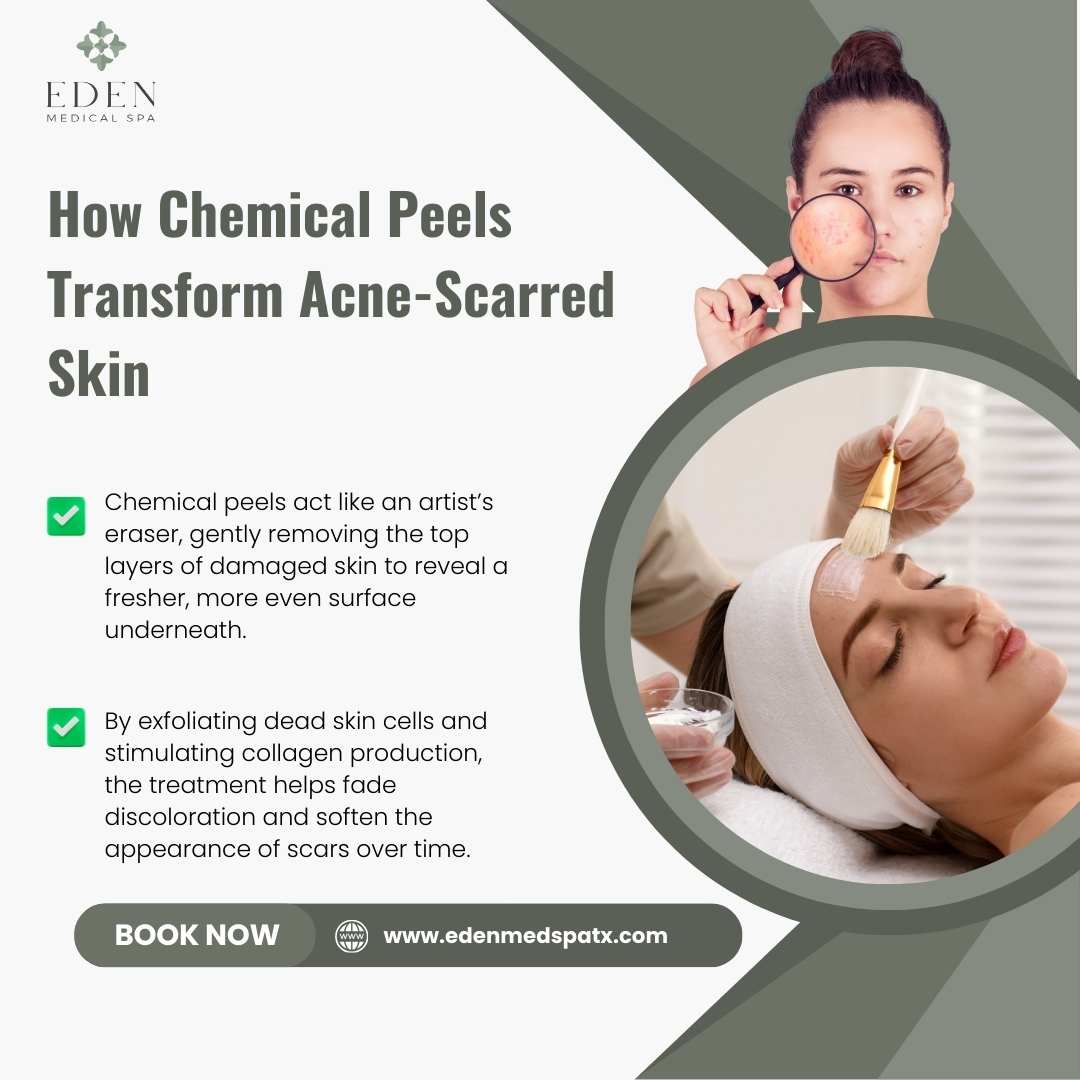 How Chemical Peels Transform Acne-Scarred Skin